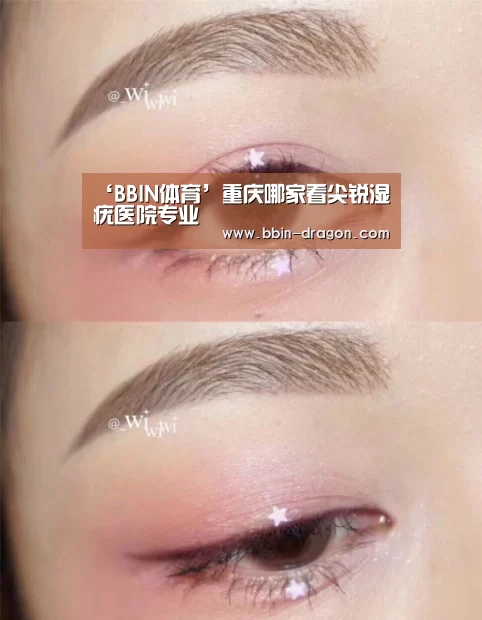 ‘BBIN体育’重庆哪家看尖锐湿疣医院专业(图4) BBIN篮球